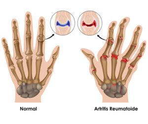 arthritis treatment