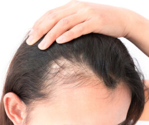 hair-loss treatment